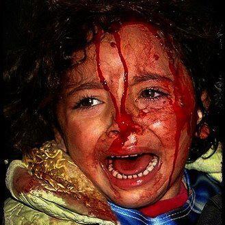 Click on image to see full-sized version Child Injured By Israeli Shells